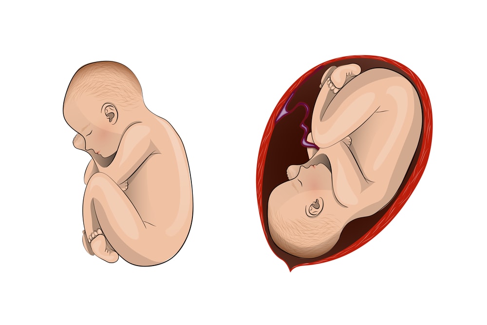 Descolamento-de-placenta.jpg