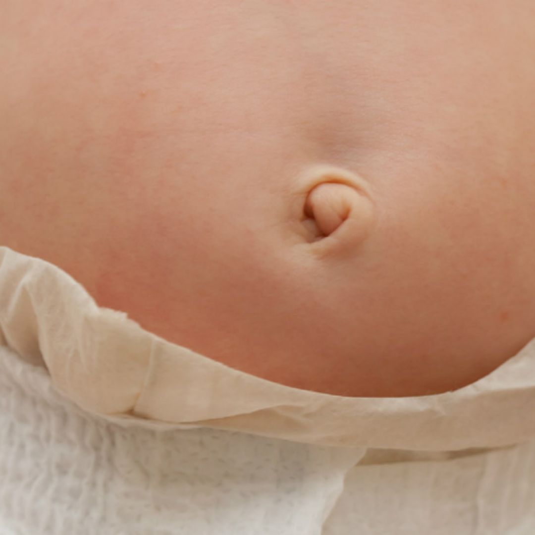 umbigo-bebe-hernia-umbilical-0318-1400x800-1.jpg