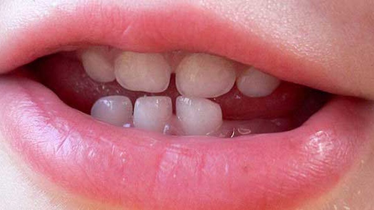 Dente-de-leite-1802-1200x675.jpg